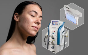 Эффективность и безопасность интенсивного импульсного света с использованием нового фильтра в лечении воспалительного акне (acne vulgaris)