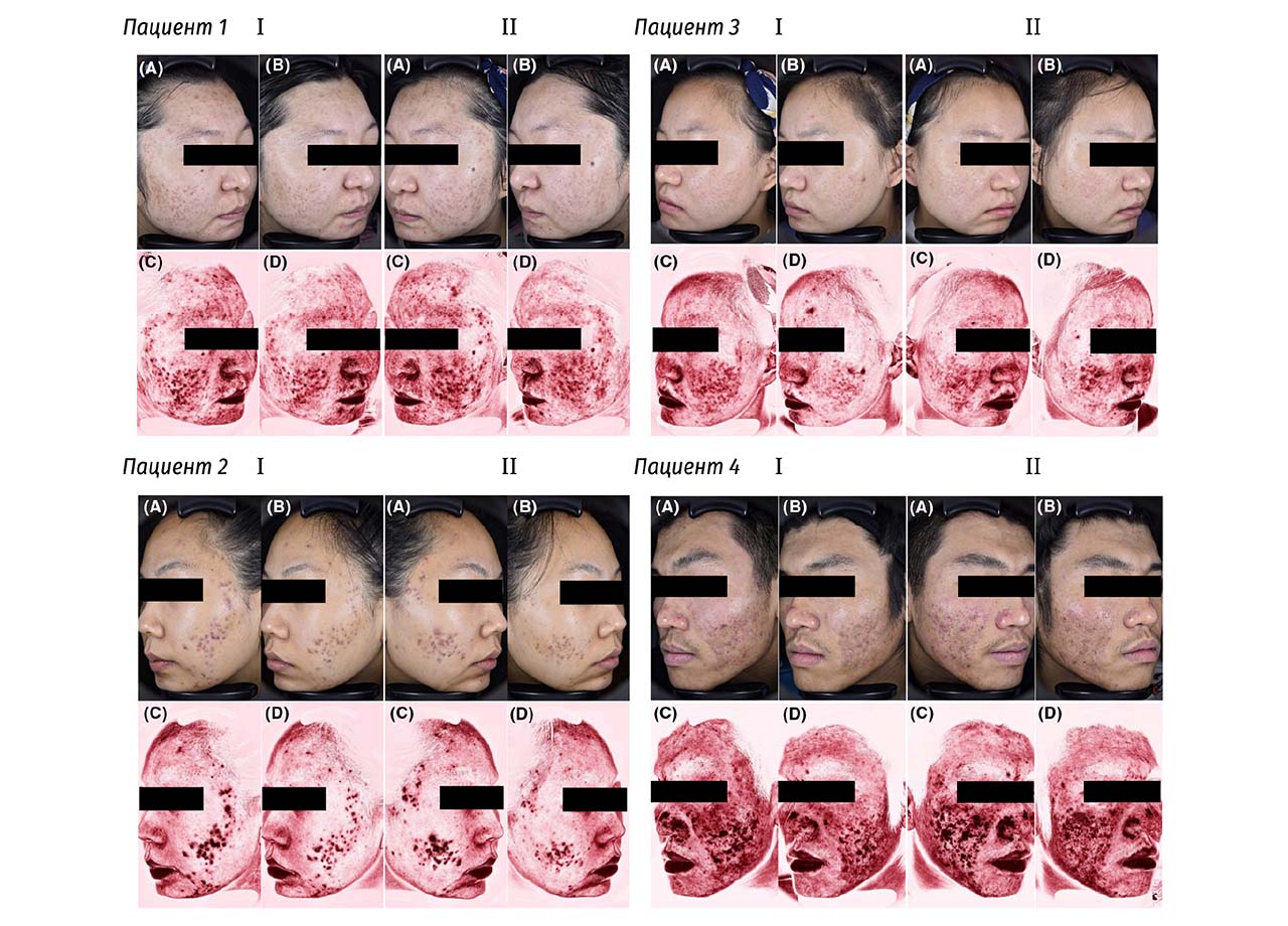 Рисунок 1. «Spilt-face» cравнение изображений четырех субъектов с эритематозными рубцами постак-
не, полученных при помощи CBS®, до и после лечения.