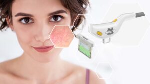 Ретроспективный анализ результатов лечения телеангиэктазий на лице с применением импульсного лазера на красителе и интенсивного импульсного света с различными диапазонами длин волн