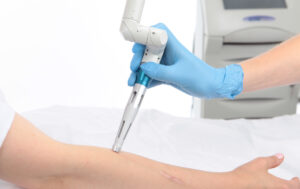 Scaar FX Ultrapulse Lumenis: последние новости в лечении рубцов