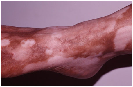 vitiligo3 1