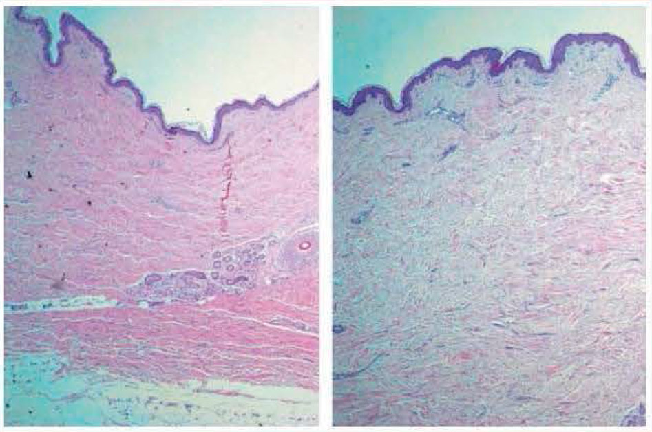Микроскопия  кожи  живота: а  - до  процедуры,  б - после  воздействия модуля  TriPollar RF.  Отмечается  утолщение  дермы