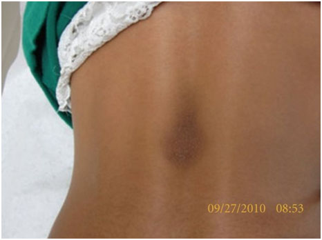 Аномальные пигментации кожи, проявления заболевания, методики лечения на аппарате M22