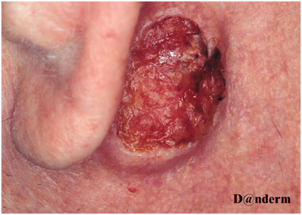 Немеланоцитарный рак кожи - сквамозно-клеточная карцинома