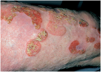 Немеланоцитарный рак кожи - грибовидный микоз