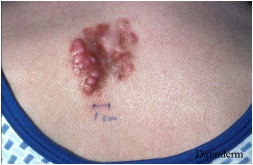 Немеланоцитарный рак кожи - выбухающая дерматофибросаркома