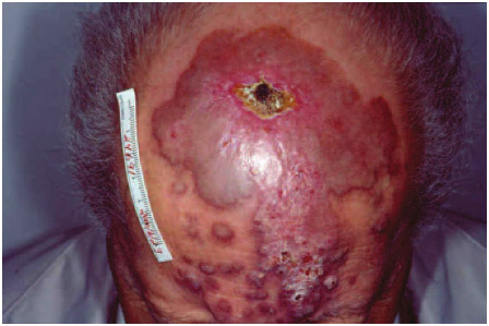 Немеланоцитарный рак кожи - крупная ангиосаркома