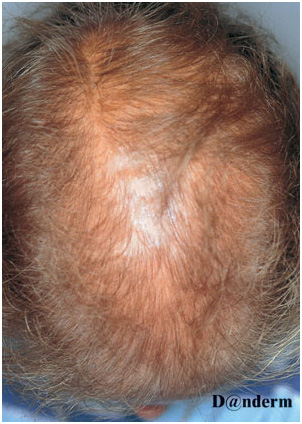 Заболевания волос - алопеция после химиотерапии