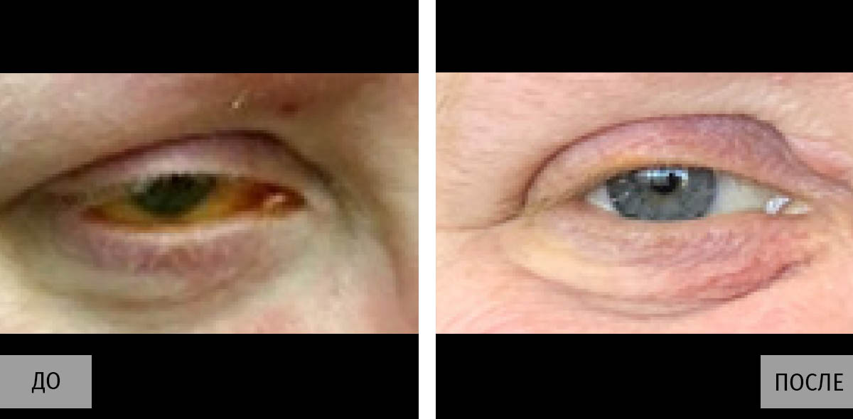 Купить аппарат Optima IPL (M22) для лечения болезни сухого глаза - Premium  Aesthetics