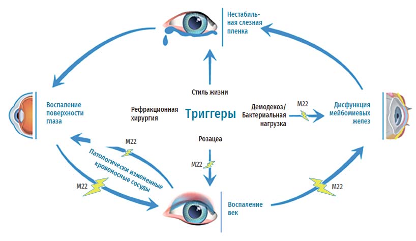 Новое в лечении синдрома сухого глаза