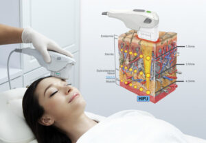 Чего ожидать от SMAS-лифтинга на аппарате ультразвуковой HIFU-терапии?