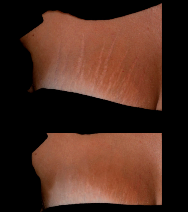 Применение неаблятивного фракционного лазера (1565 нм) для лечения стрий кожи